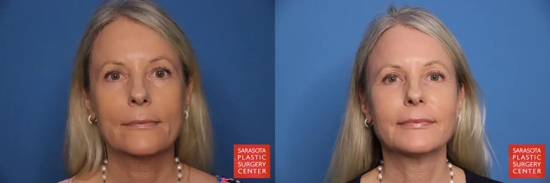 Laser Skin Resurfacing - Face: Patient 35 - Before and After  
