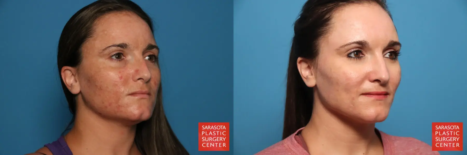 Laser Skin Resurfacing - Face: Patient 34 - Before and After 4