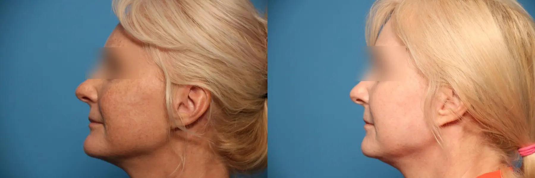 Laser Skin Resurfacing - Face: Patient 6 - Before and After 3