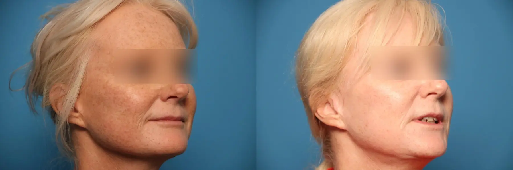 Laser Skin Resurfacing - Face: Patient 6 - Before and After 4