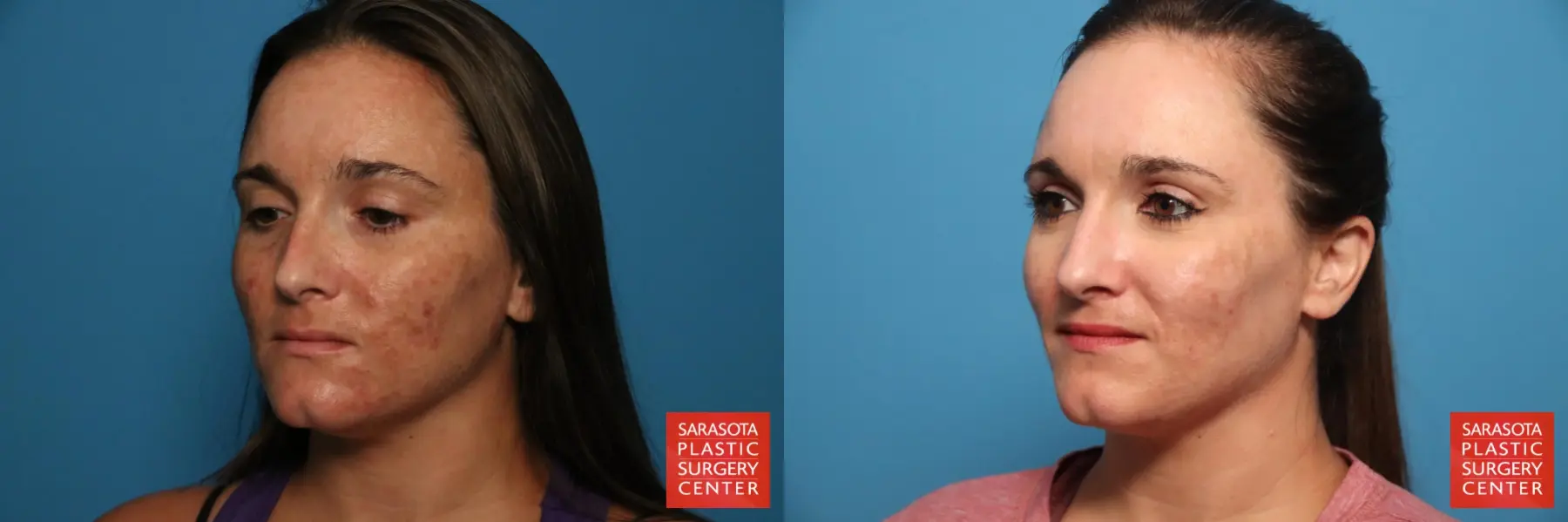 Laser Skin Resurfacing - Face: Patient 34 - Before and After 2