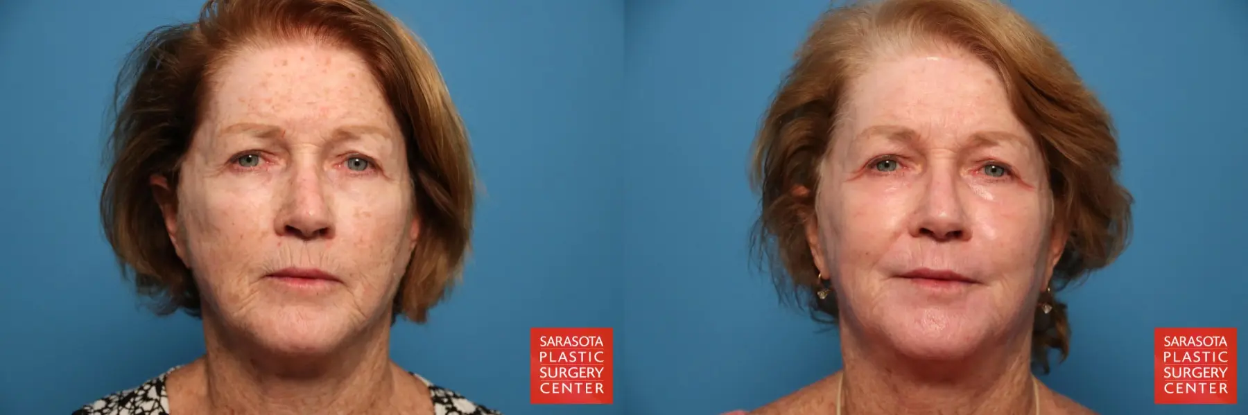Laser Skin Resurfacing - Face: Patient 16 - Before and After  