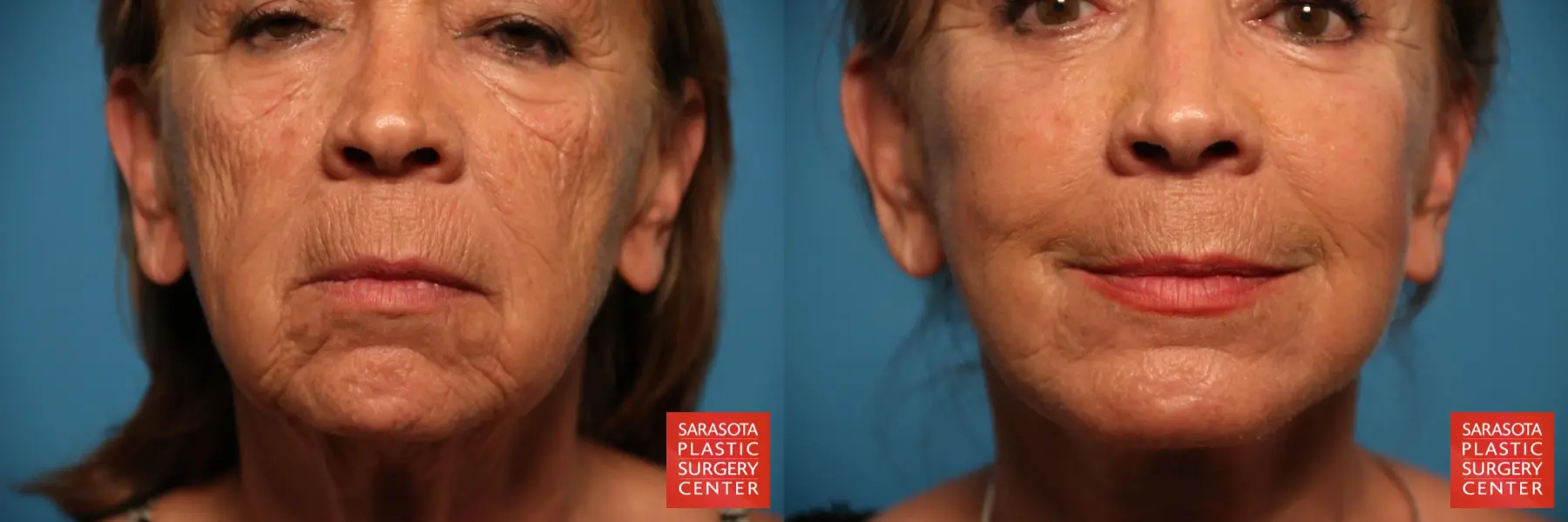 Laser Skin Resurfacing - Face: Patient 28 - Before and After  