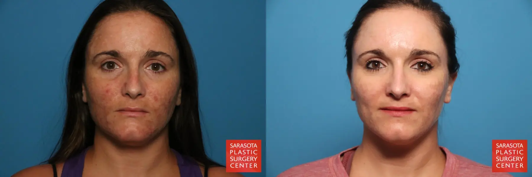 Laser Skin Resurfacing - Face: Patient 34 - Before and After 1