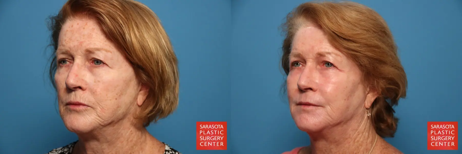 Laser Skin Resurfacing - Face: Patient 16 - Before and After 2