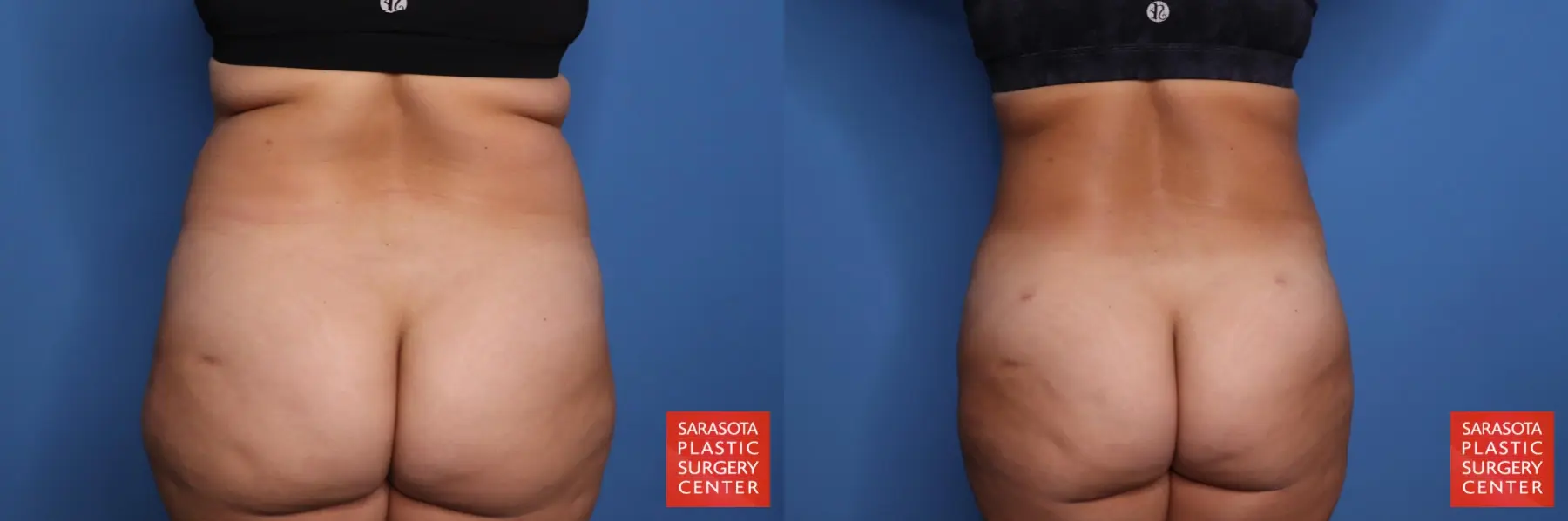 Liposuction: Patient 57 - Before and After 1