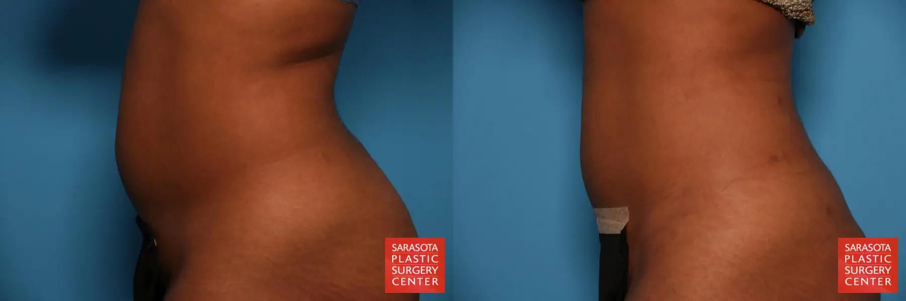 Liposuction: Patient 34 - Before and After 3