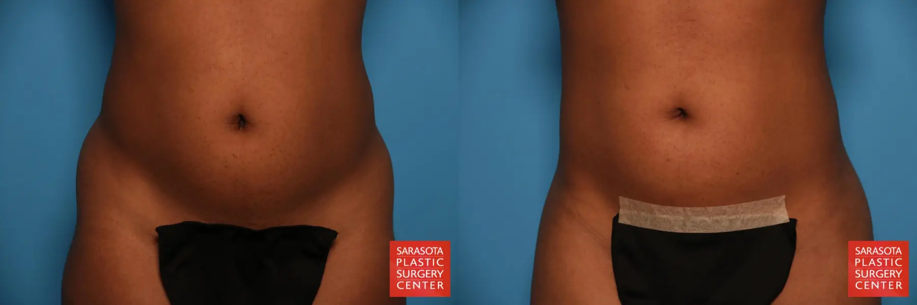 Liposuction: Patient 34 - Before and After 1