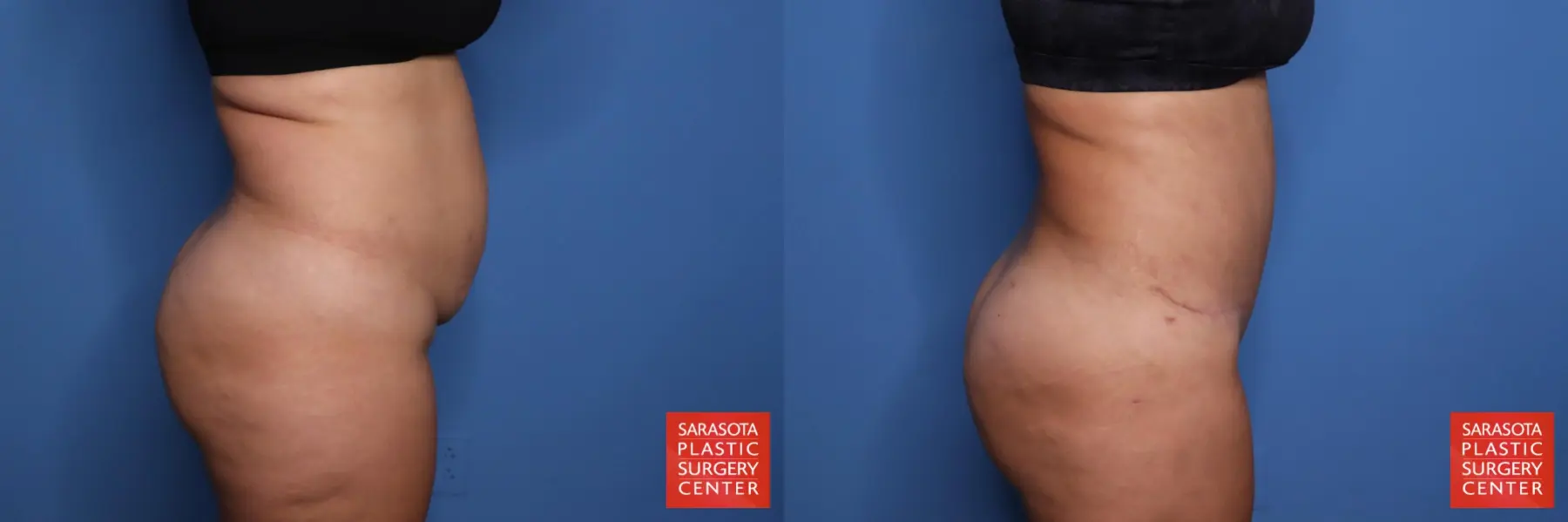 Liposuction: Patient 57 - Before and After 3