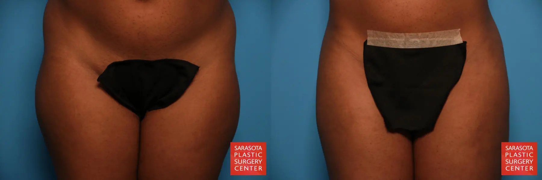 Liposuction: Patient 34 - Before and After 5