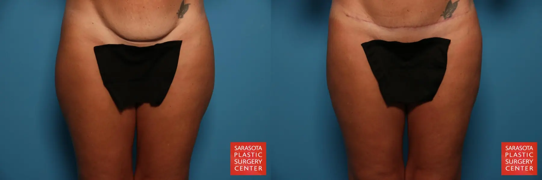 Liposuction: Patient 8 - Before and After  