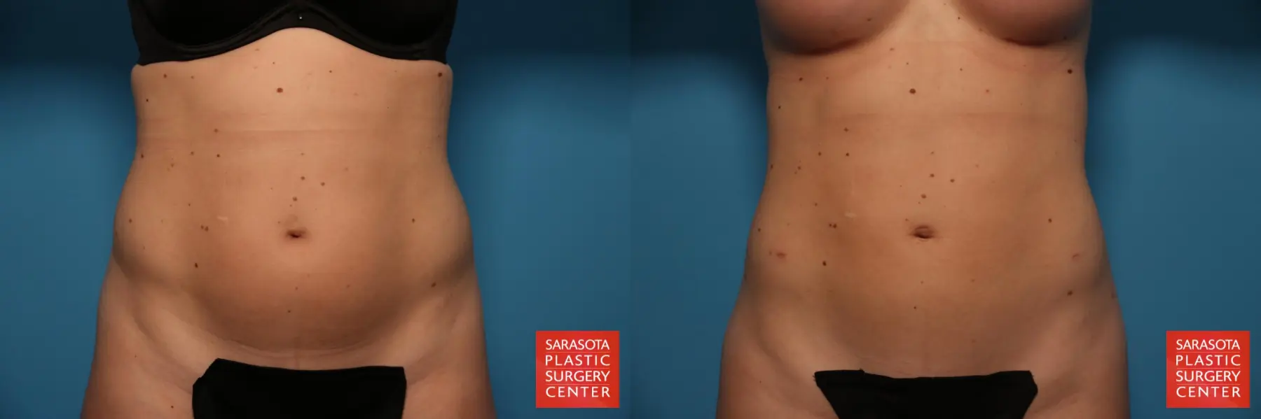 Liposuction: Patient 10 - Before and After  