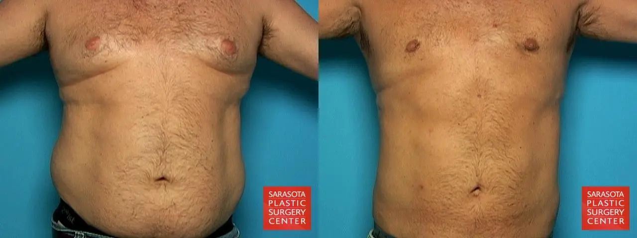 Liposuction: Patient 4 - Before and After  