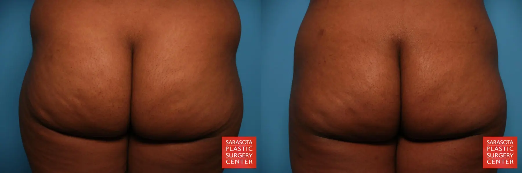 Liposuction: Patient 34 - Before and After 6