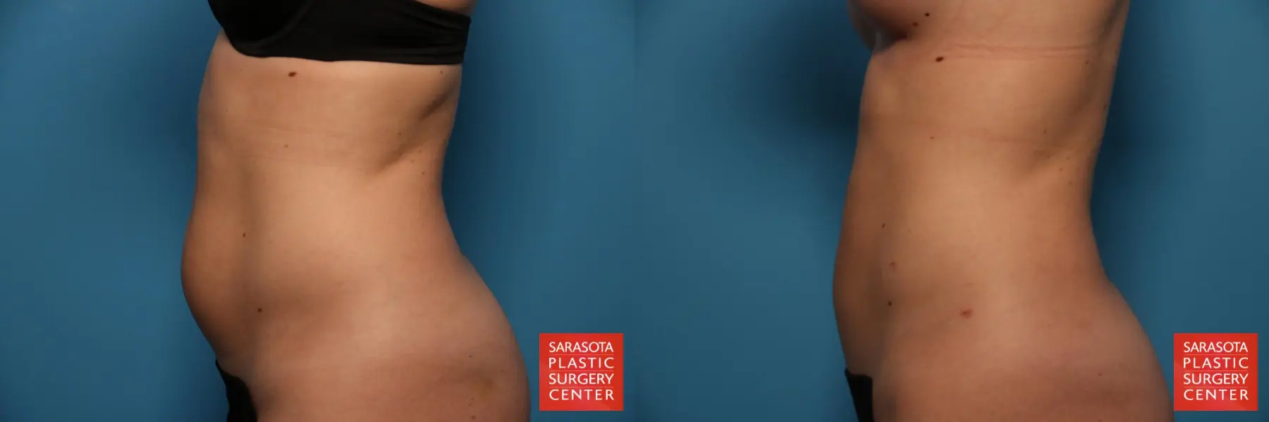 Liposuction: Patient 10 - Before and After 3