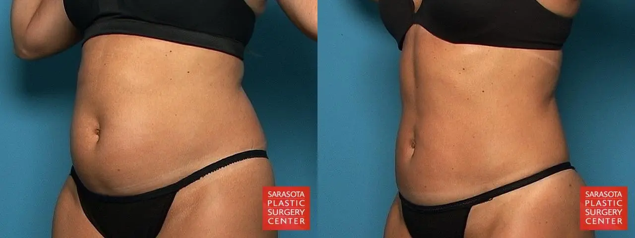 Liposuction: Patient 7 - Before and After 2