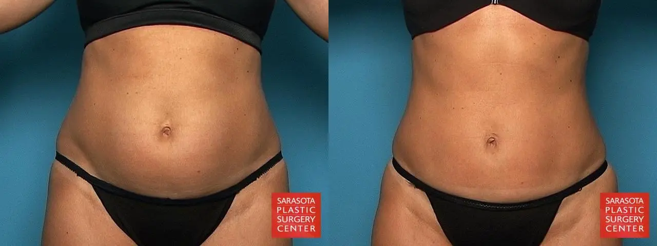 Liposuction: Patient 7 - Before and After  