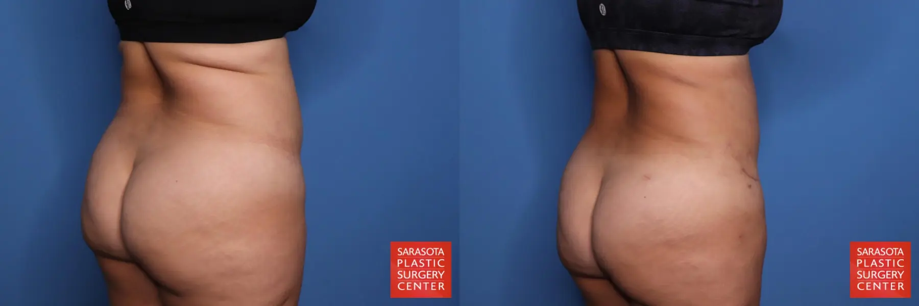 Liposuction: Patient 57 - Before and After 2