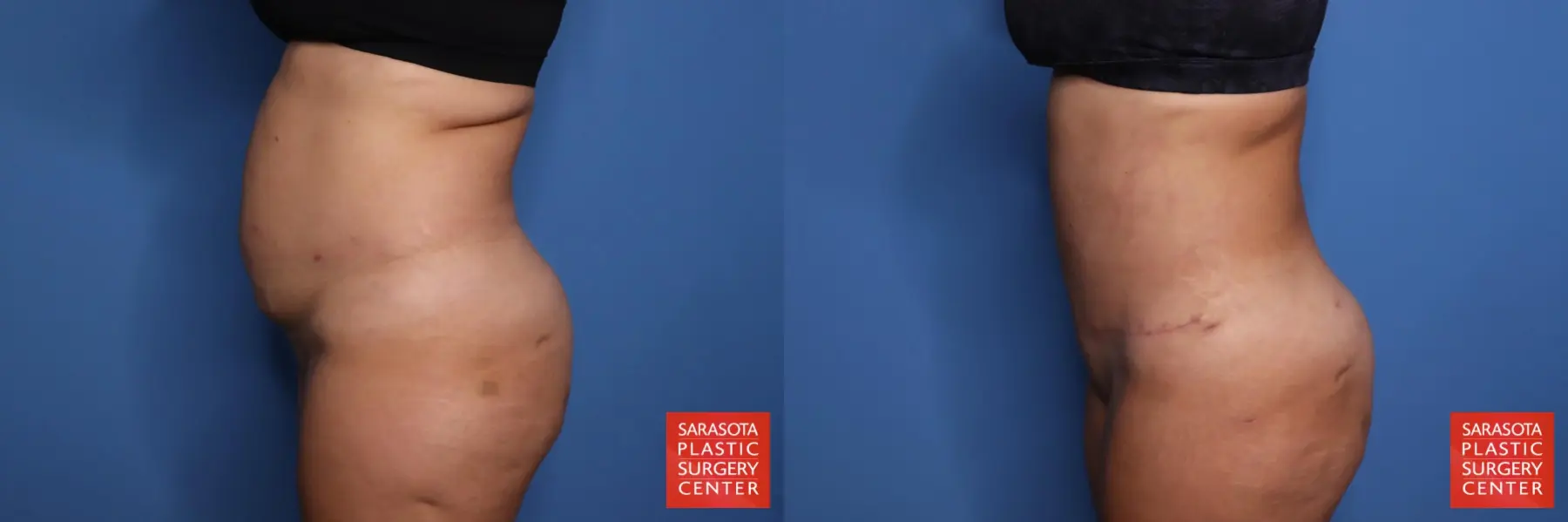 Liposuction: Patient 57 - Before and After 5
