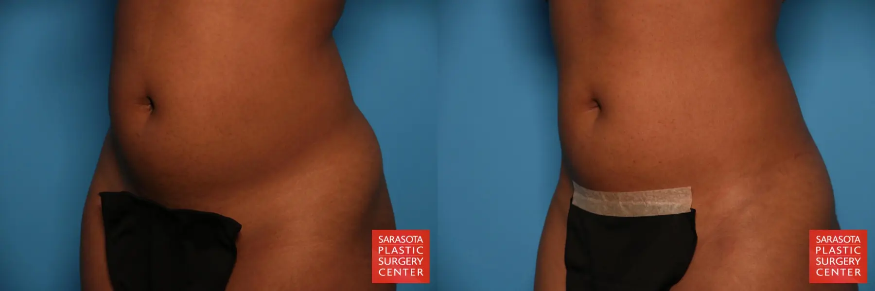 Liposuction: Patient 34 - Before and After 2