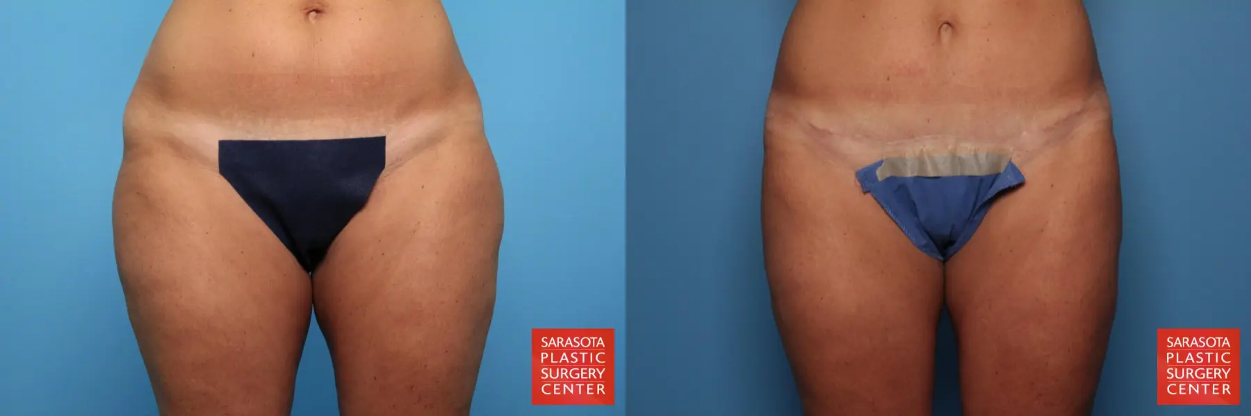 Liposuction: Patient 19 - Before and After  