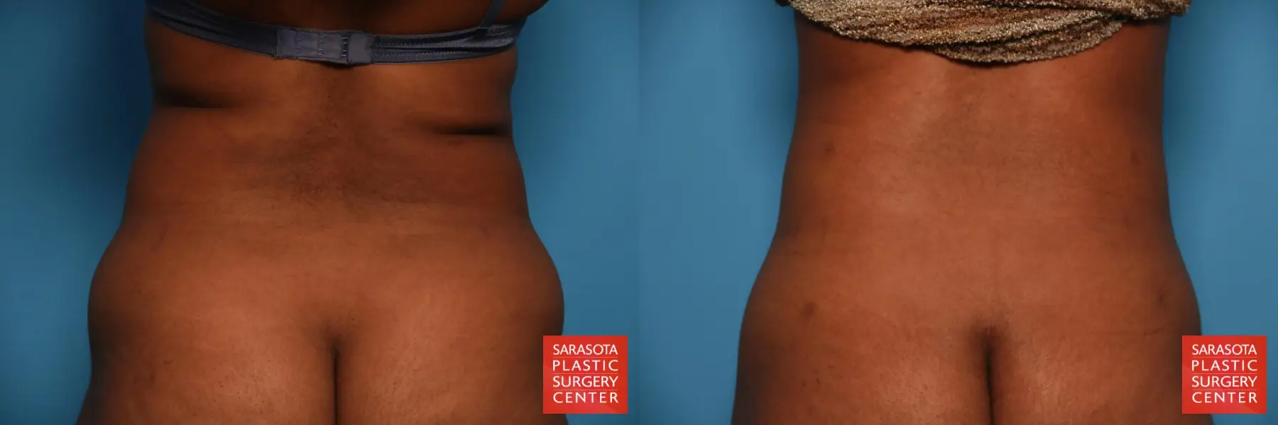 Liposuction: Patient 34 - Before and After 4