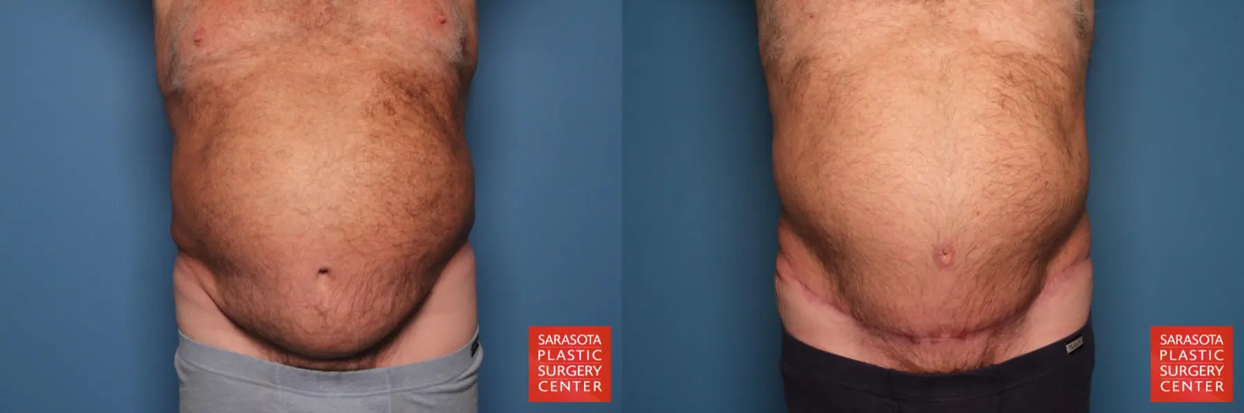 Lower Tummy Tuck : Patient 11 - Before and After  