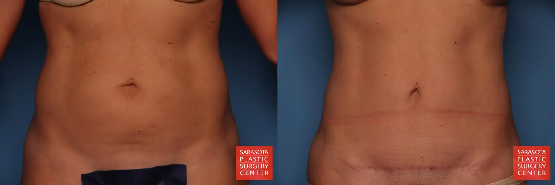 Lower Tummy Tuck : Patient 1 - Before and After  