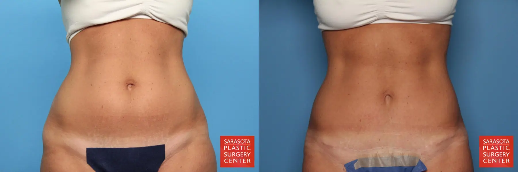 Lower Tummy Tuck : Patient 2 - Before and After  