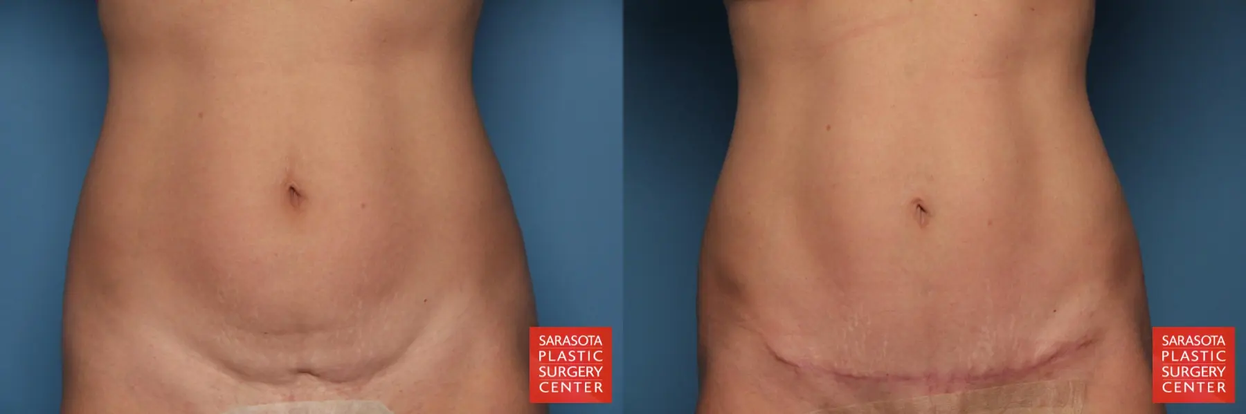 Lower Tummy Tuck : Patient 5 - Before and After  