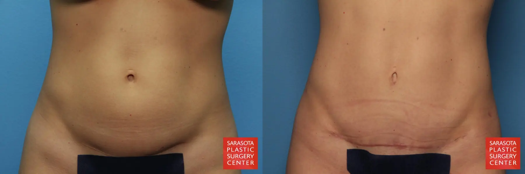 Lower Tummy Tuck : Patient 4 - Before and After  