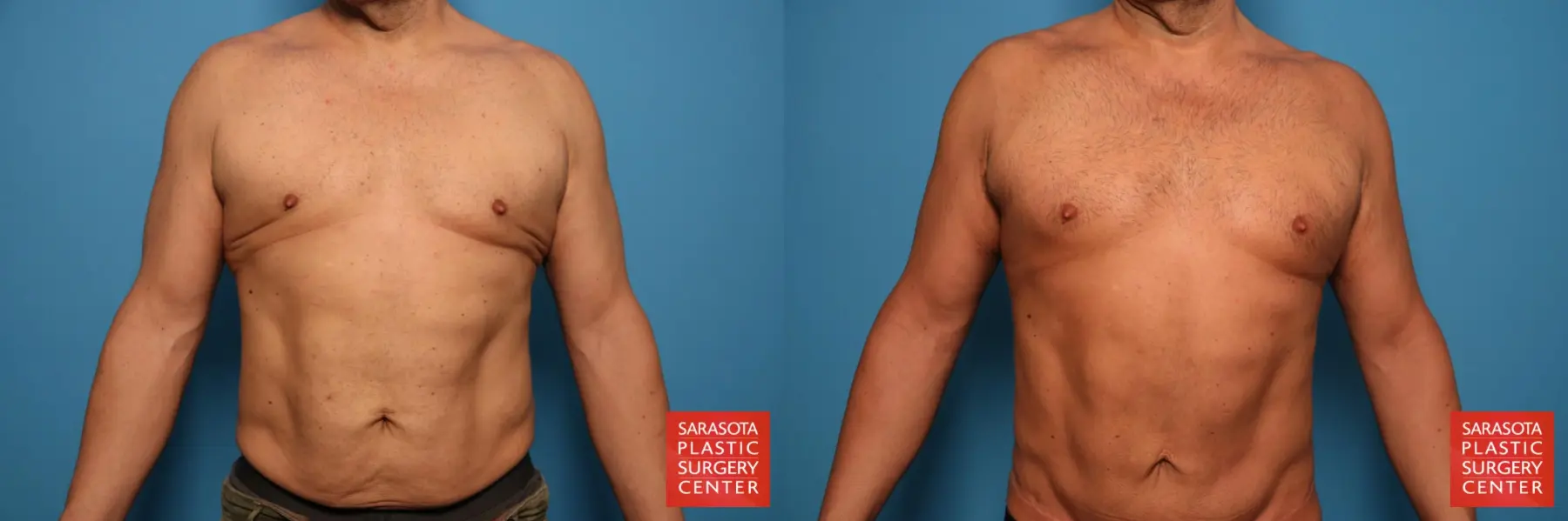 Lower Tummy Tuck : Patient 8 - Before and After  