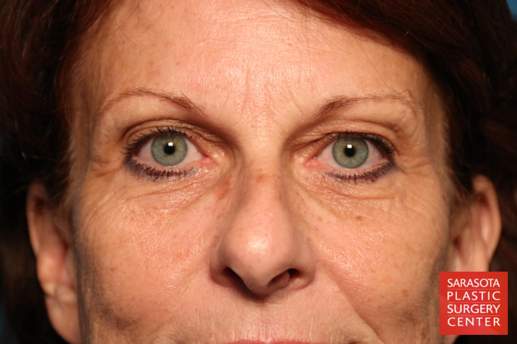 Eyelid Surgery: Patient 25 - Before 