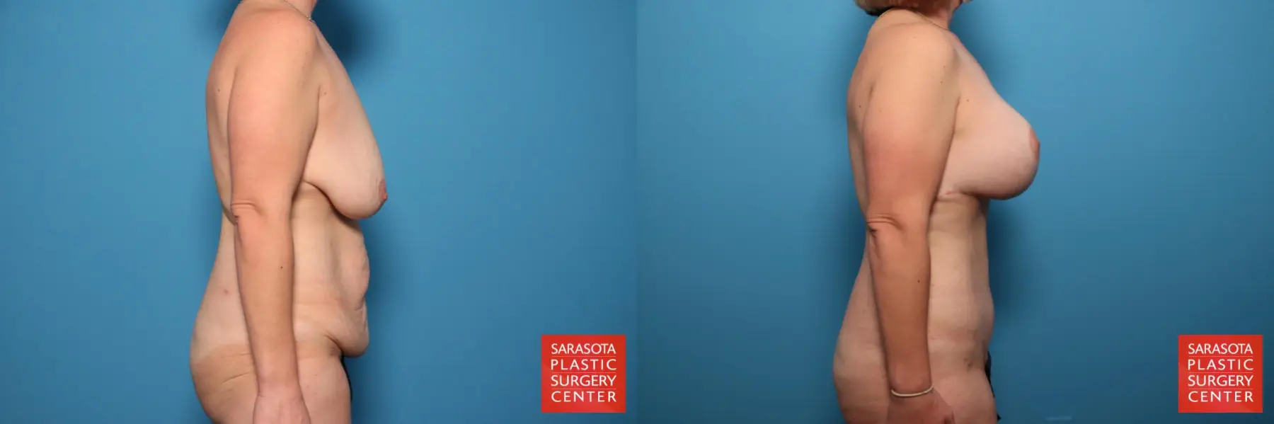 Mommy Makeover: Patient 6 - Before and After 3