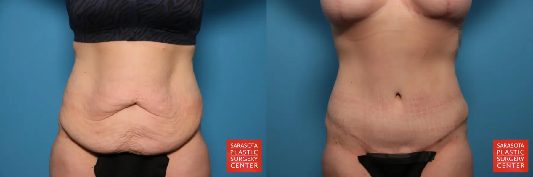 Mommy Makeover: Patient 6 - Before and After 7