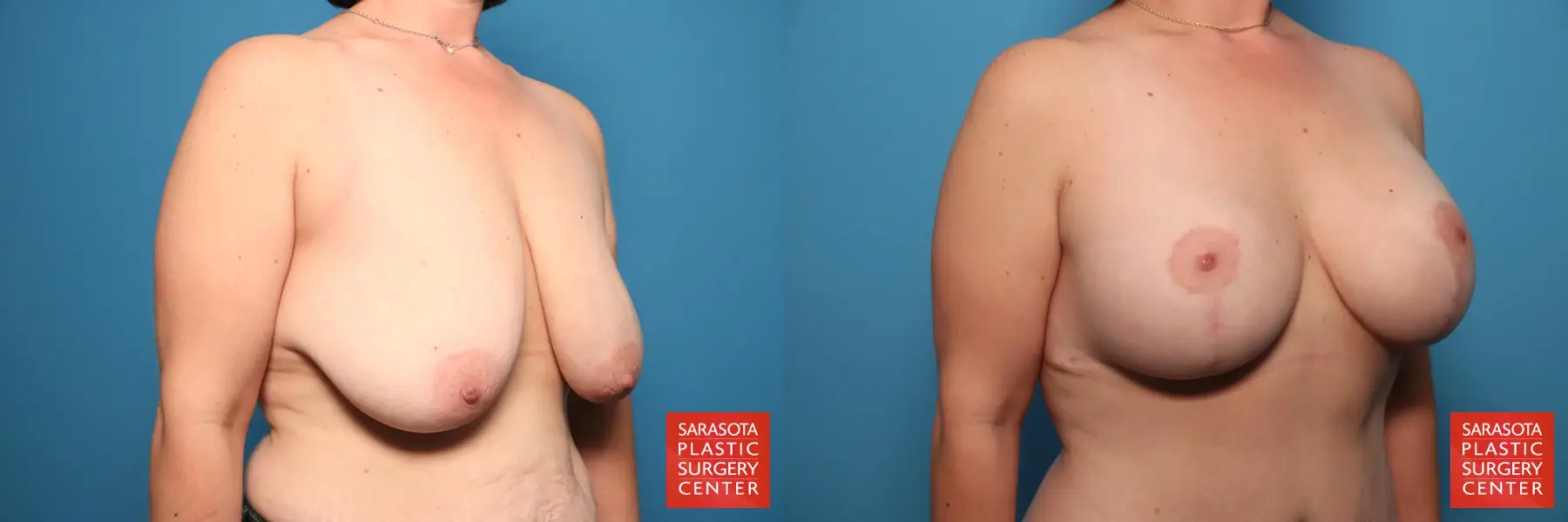 Mommy Makeover: Patient 6 - Before and After 5