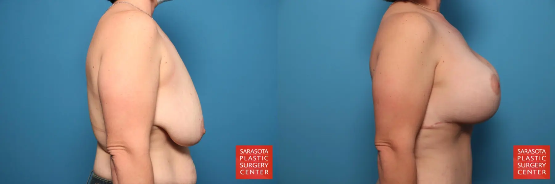 Mommy Makeover: Patient 6 - Before and After 6