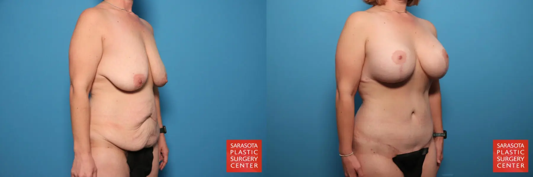 Mommy Makeover: Patient 6 - Before and After 2