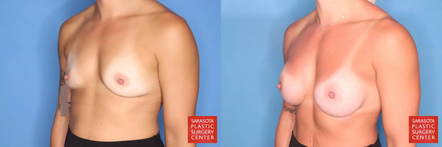 Motiva Implants: Patient 1 - Before and After 2