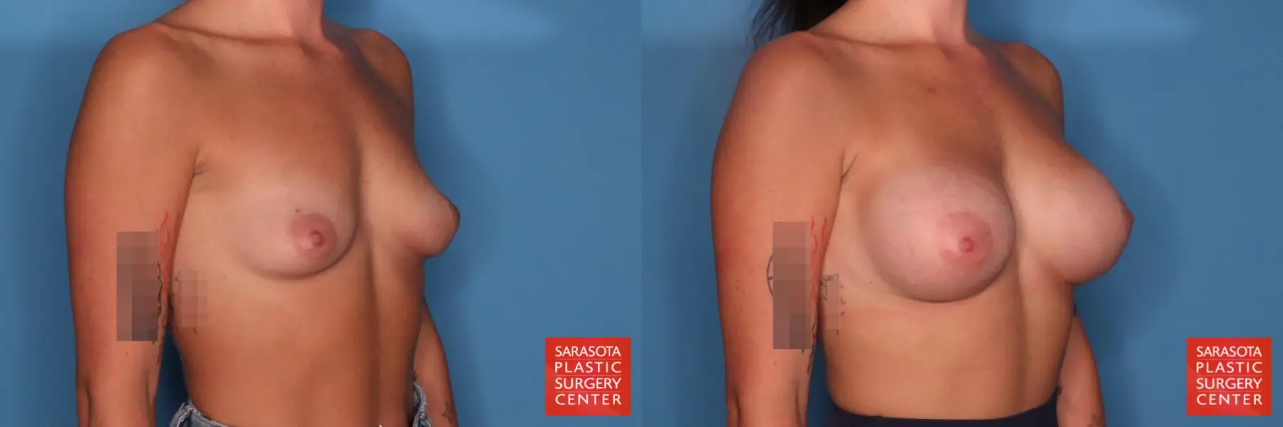 Motiva Implants: Patient 2 - Before and After 4