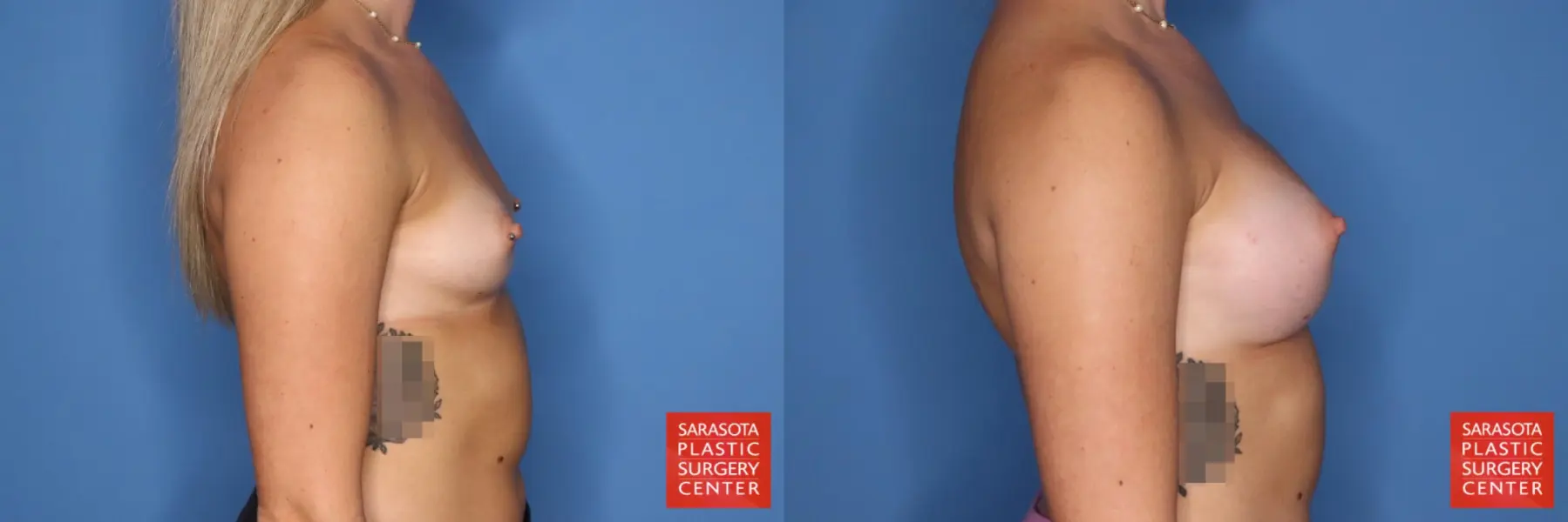 Motiva Implants: Patient 5 - Before and After 5