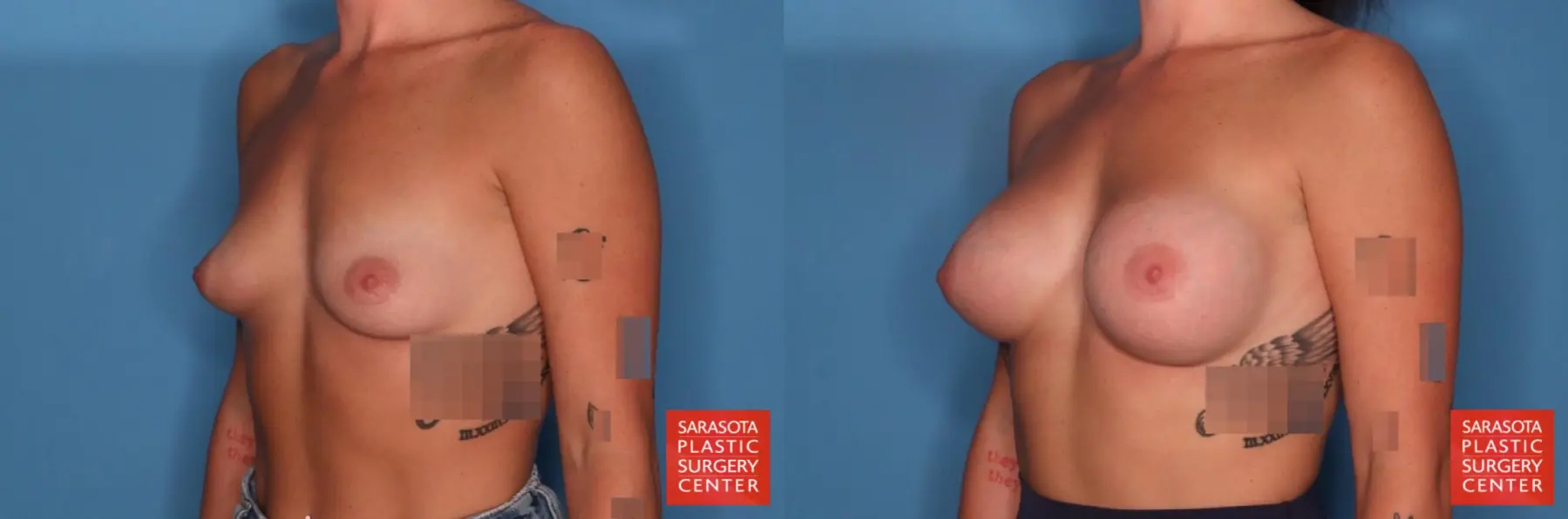 Motiva Implants: Patient 2 - Before and After 2