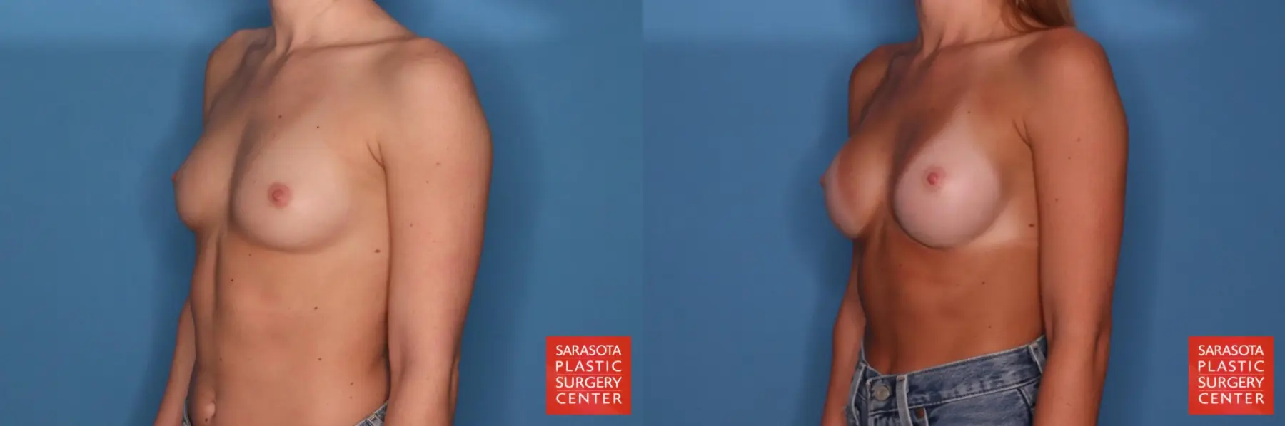Motiva Implants: Patient 11 - Before and After 2