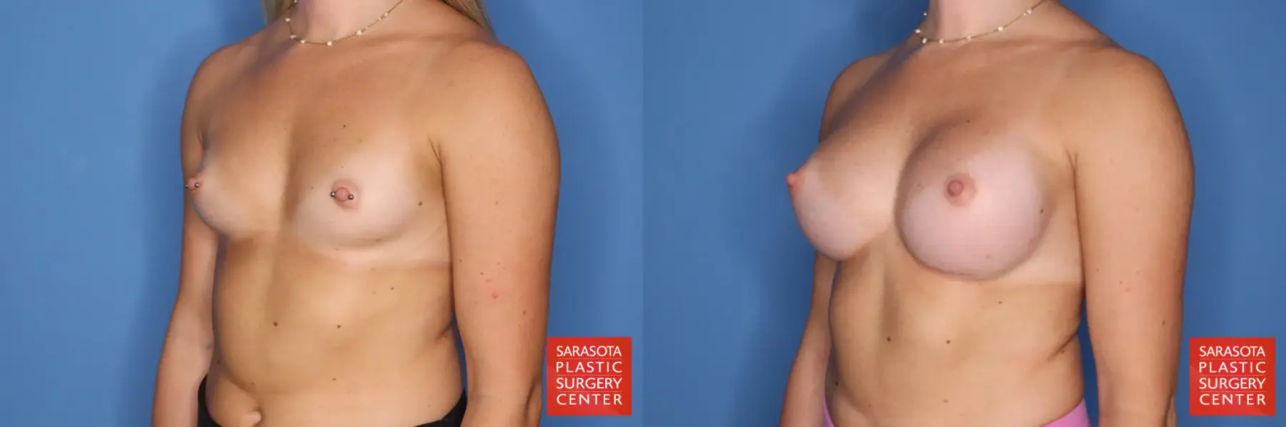Motiva Implants: Patient 5 - Before and After 2