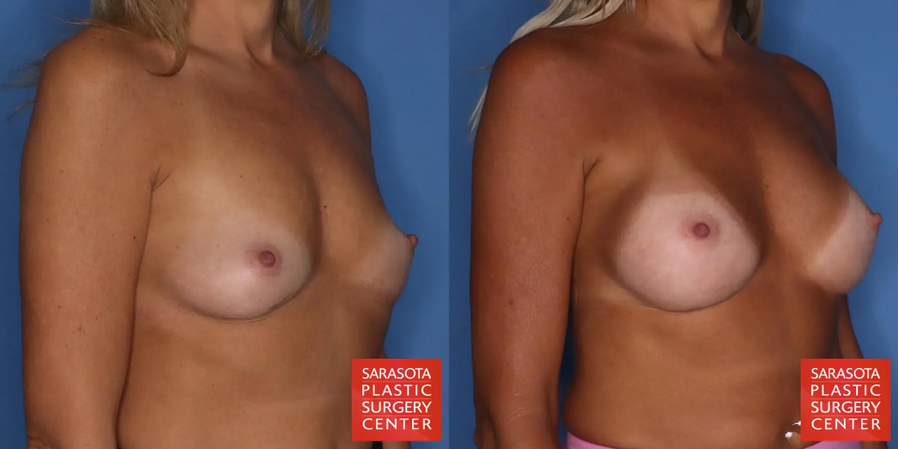Motiva Implants: Patient 10 - Before and After 2