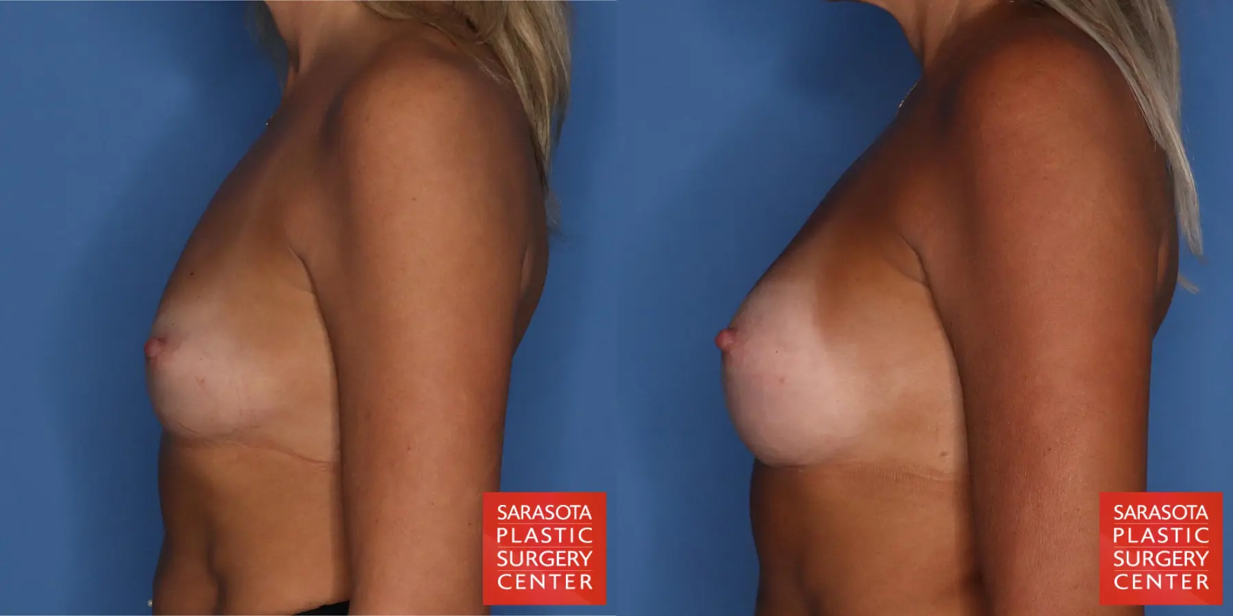Motiva Implants: Patient 10 - Before and After 5