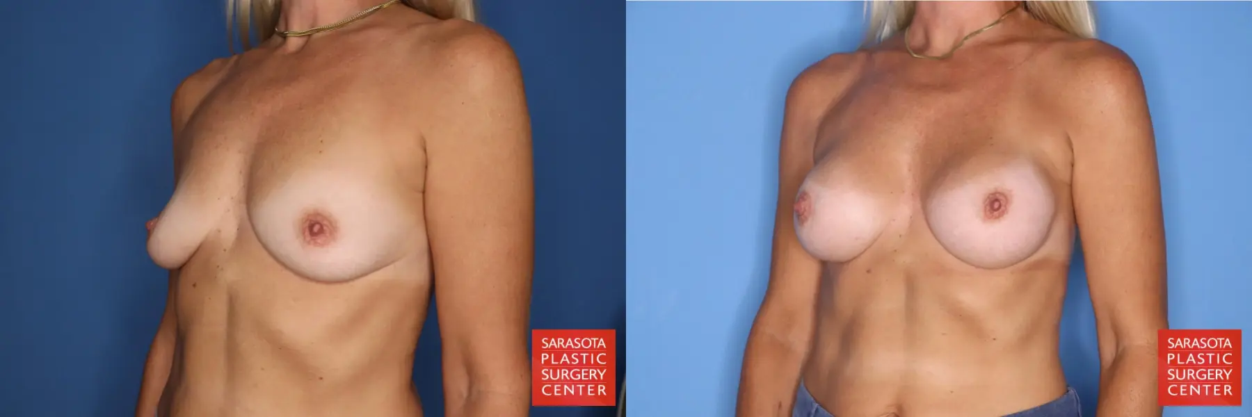 Motiva Implants: Patient 8 - Before and After 4
