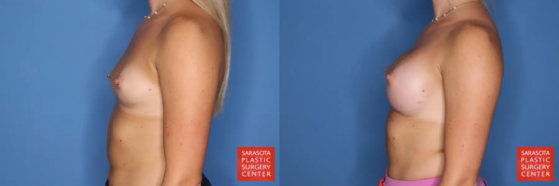 Motiva Implants: Patient 5 - Before and After 3