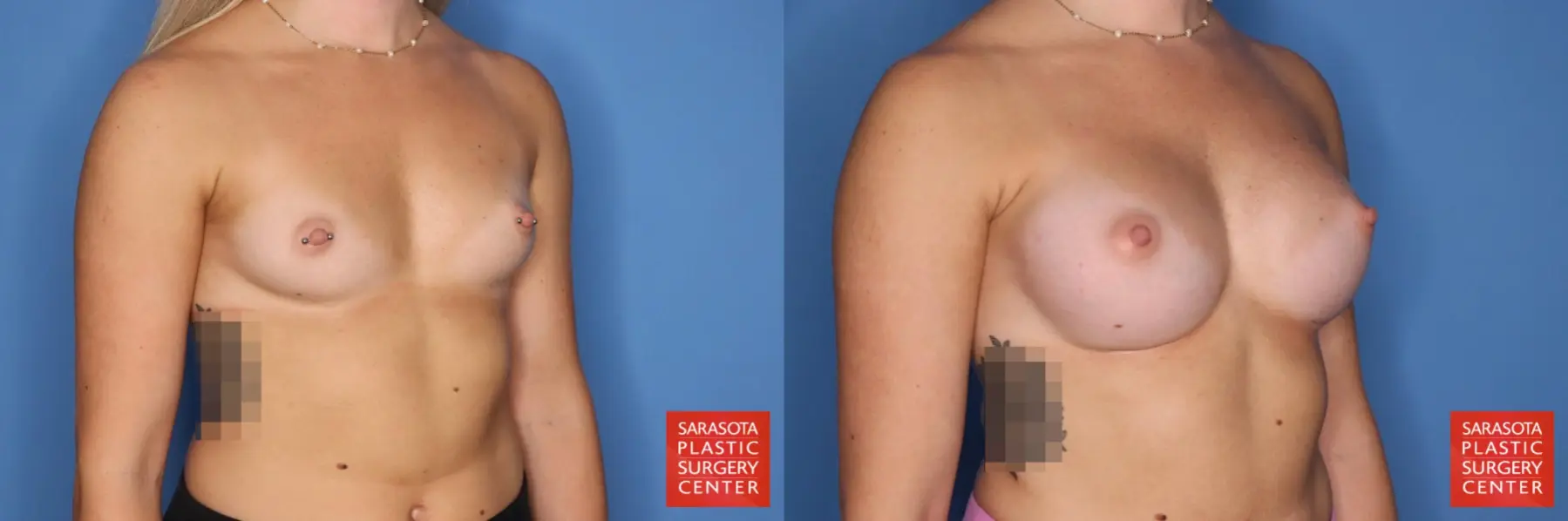 Motiva Implants: Patient 5 - Before and After 4