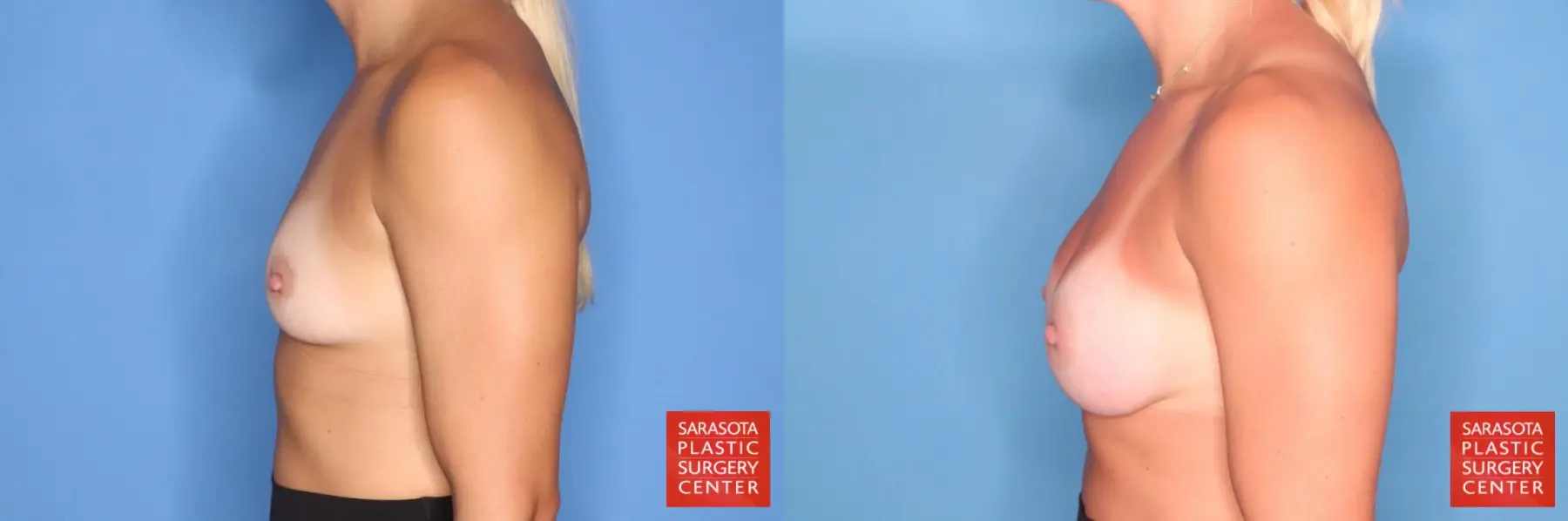 Motiva Implants: Patient 1 - Before and After 3